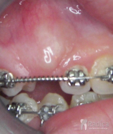 laser-prikazivanje-zuba-4
