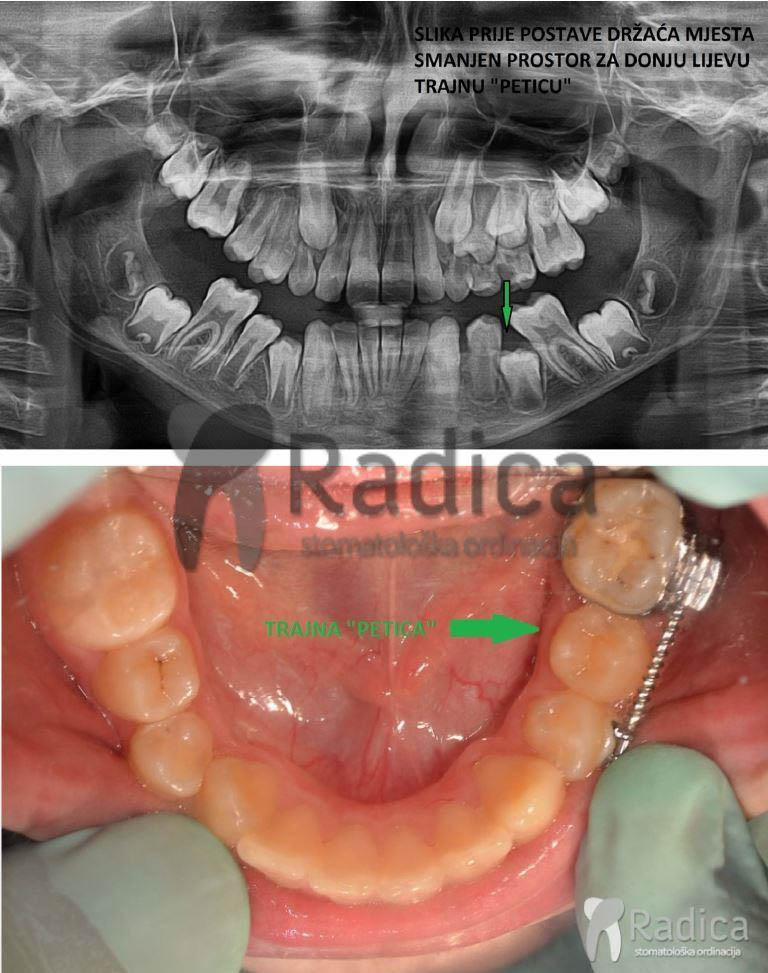 drzac_mjesta_ortodont_radica