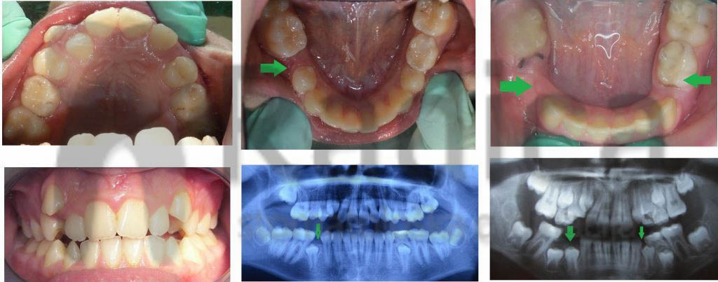 gubitak_mliječnih _zuba_ortodont_radica