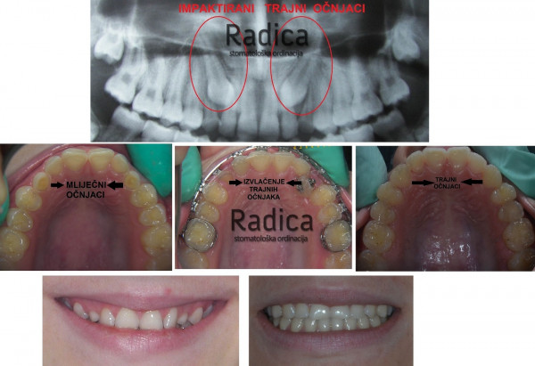 01izvlacenjeocnjakaortodontradicasplit 600x411 1767739184383 231527174