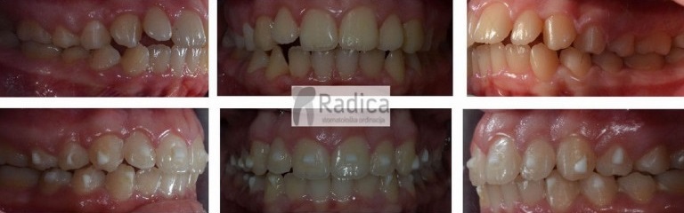 06nevidljiviaparaticzazubeortodontradicasplit 1771570518811 311236842
