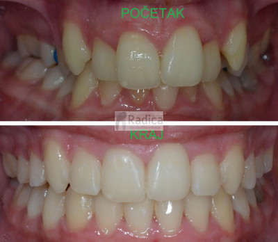 14primjer7krajaparatzasirenjenepcaortodontradicasplit 400x348 1767819320858 369247680