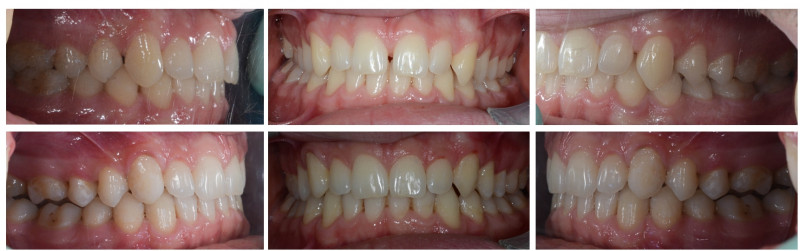 17ortodont radica invisalign split nevidljivi aparatic 800x251 1767550160686 426620591
