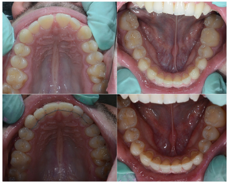 18ortodont radica invisalign split nevidljivi aparatic 02 1772053571085 758248883 1773822978345 209092090