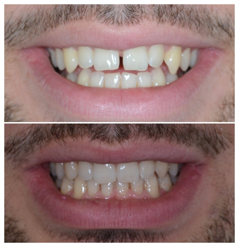 19ortodont radica invisalign split nevidljivi aparatic 03 1772053575064 4811423