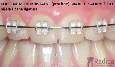 Safirni Ice fiksni aparatic ortodont radica 1770205709310 658887823