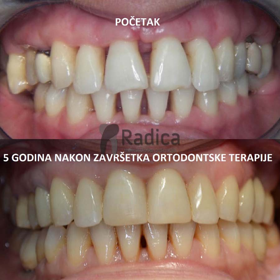 fiksni ortodontski aparatic za odrasle ortodont radica split 3 1770205399159 736722845