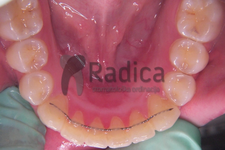 fiksniretainer ortodontradica 1100 768x514 1769202007387 230425017