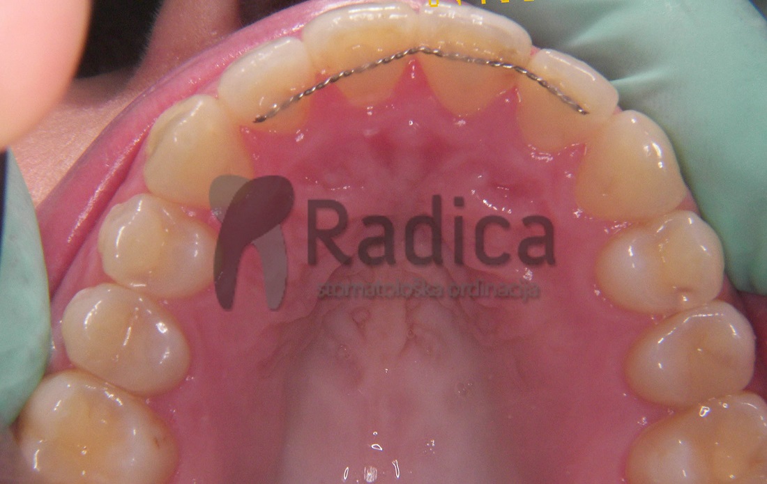 fiksniretainerortodont radica 1100 1769201994322 8666908