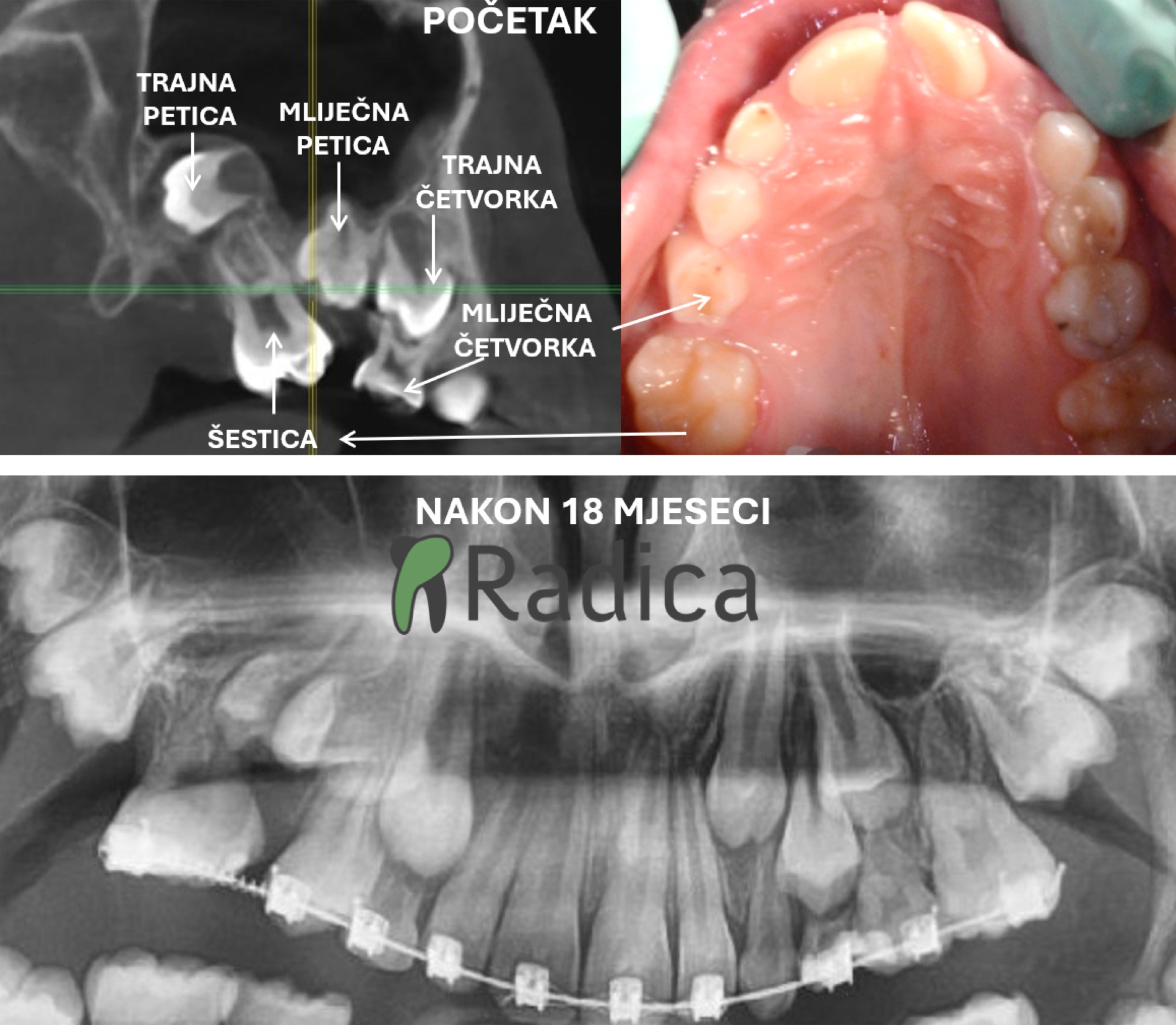 impakcija zuba ortodont radica split