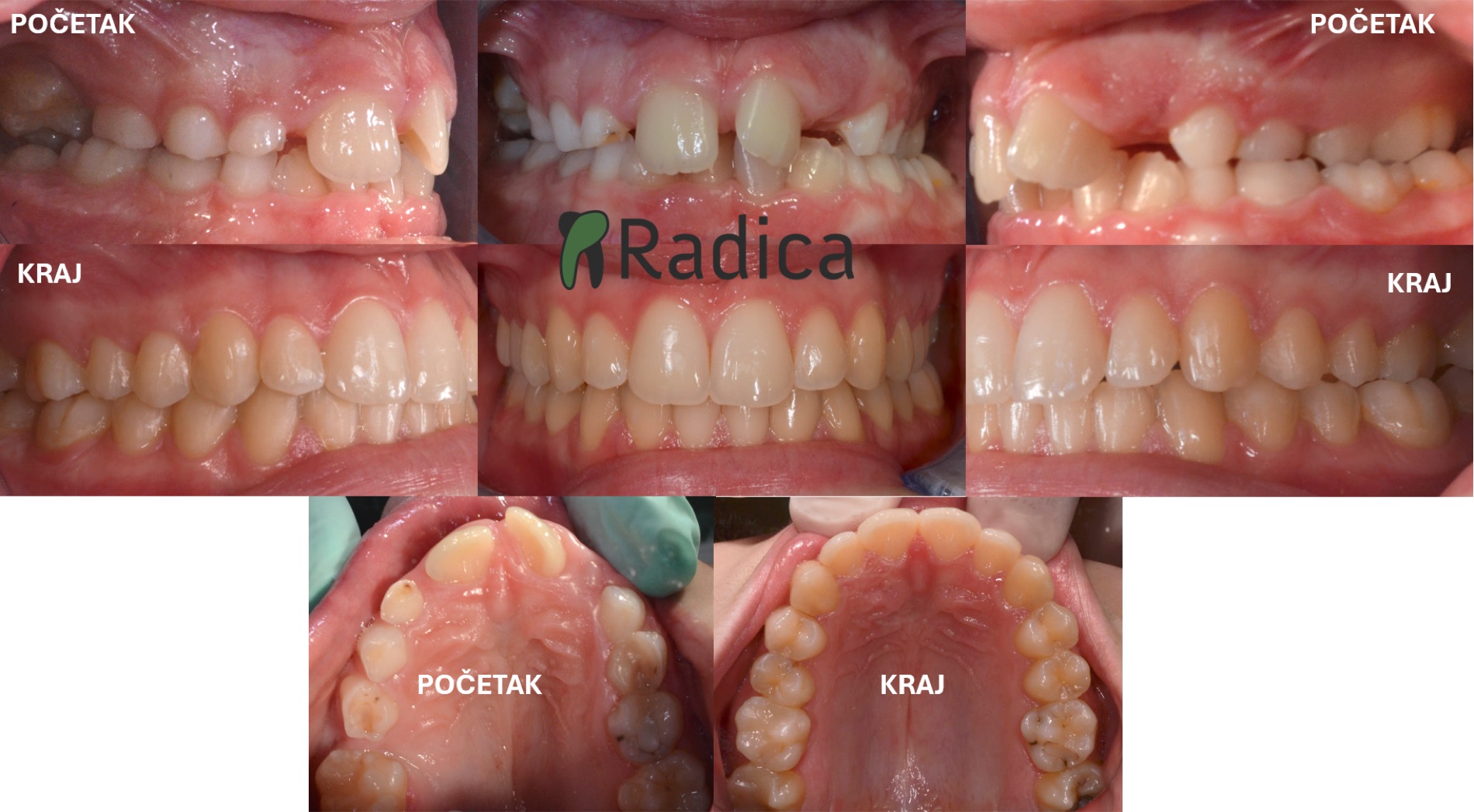 impaktirani zubi ortodont split radica