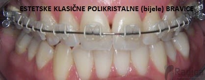 klasicni estetski ortodontski aparatic ortodoncija radica 1770205930766 659236295