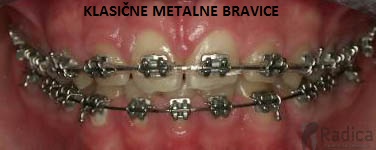 klasicni fiksni metalni aparatic ortodont radica 1770205862286 599337856