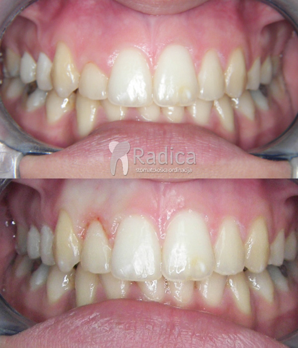 laser gingivoplastika prije poslije 2 1767897983519 8373219