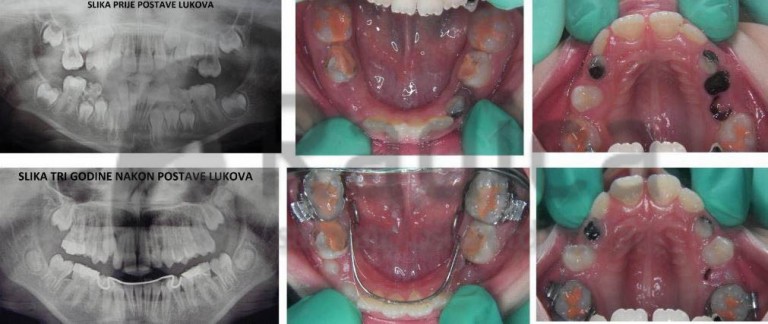 lingvalni luk ortodont radica 768x324 1770214390565 876406459