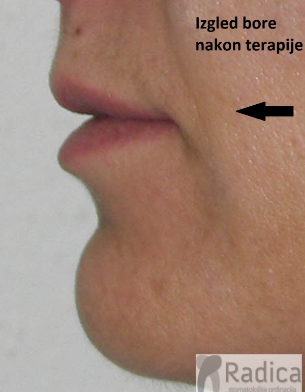 nazolabijalne bore nakon ortodontske terapije ortodont radica 600x771 1770204702221 665535382