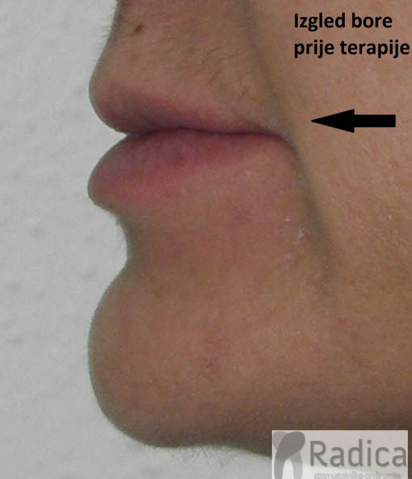 nazolabilajalne bore prije ortodontske terapije ortodont radica 600x697 1770204695306 314802649