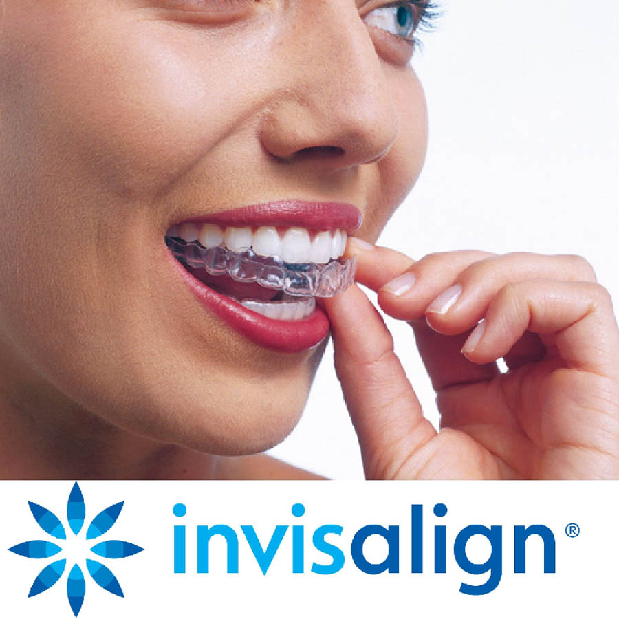 nevidljivi ortodontski aparatic invisalign ortodont radica split 1770205352307 148169569