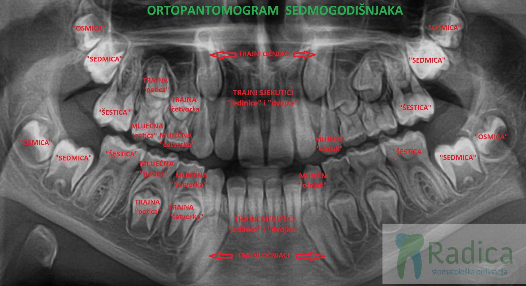 normalni zubi sedmogodinjaka ortodont radica 1770214347290 456274593