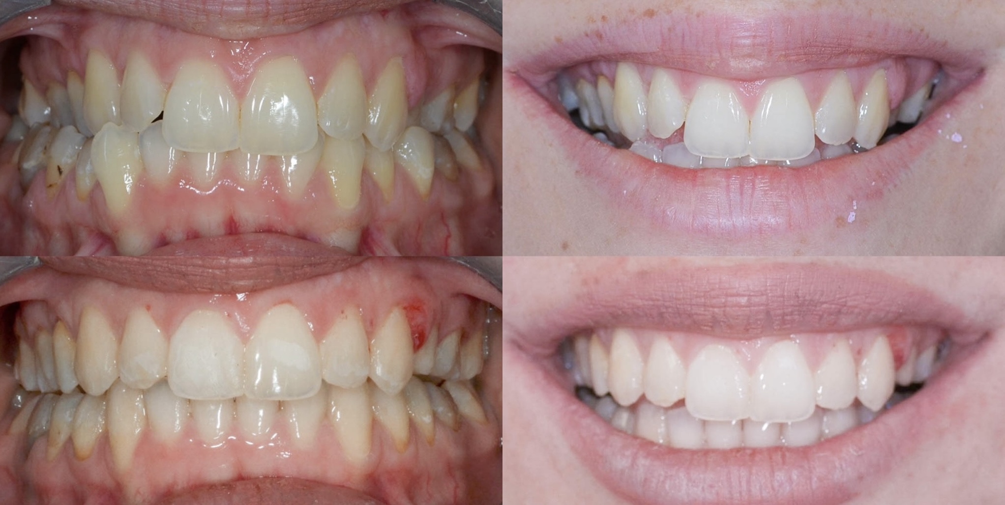 ortodont radica clear aligner 1772053201292 759605752
