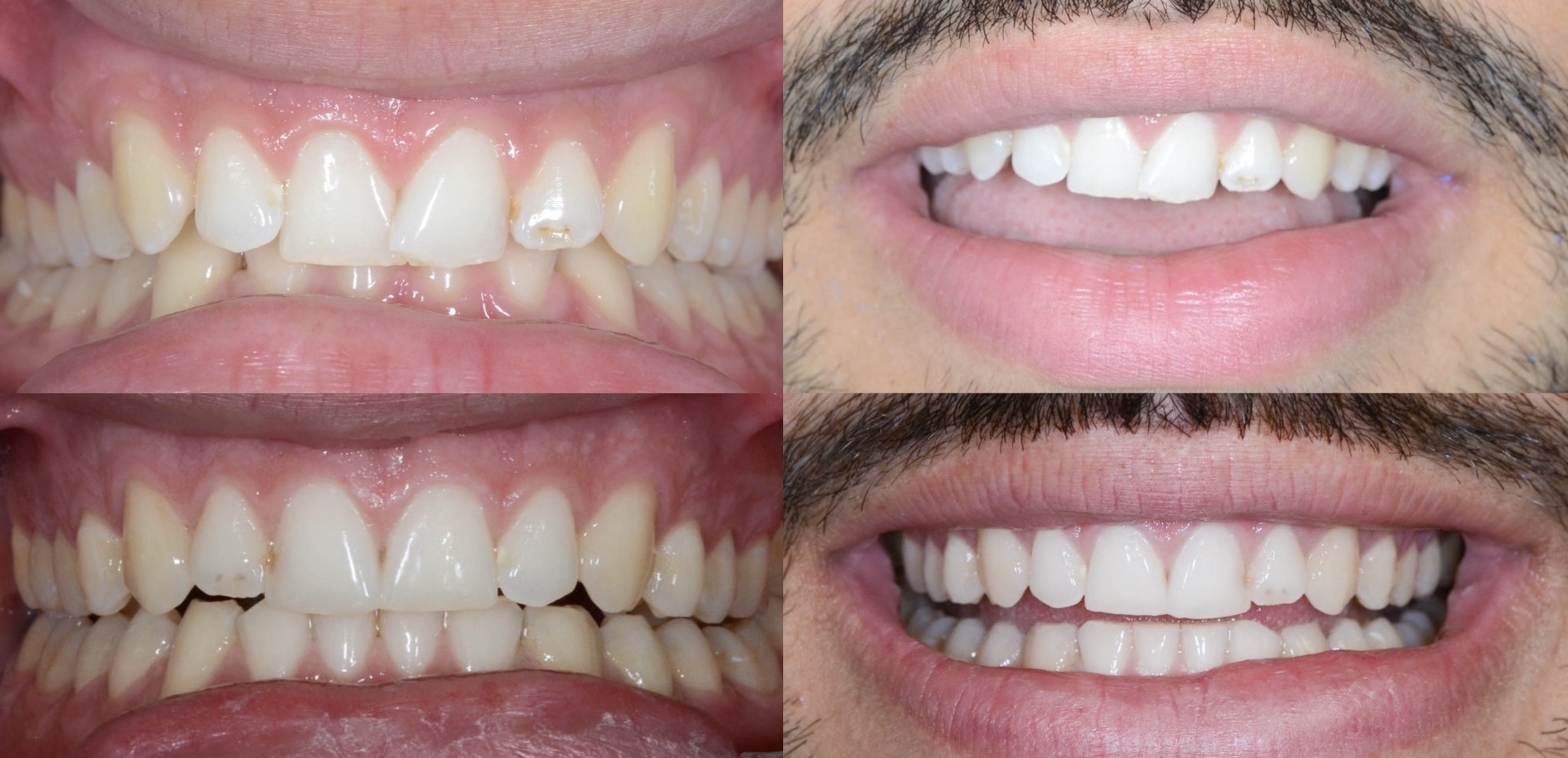 ortodont radica clear aligner aparat za zube 1772053212165 419734086 1773823098077 319234335
