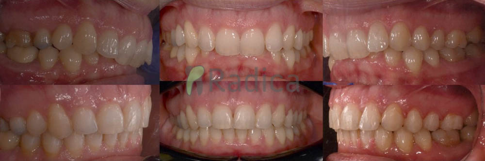 ortodont radica duboki zagriz odrasli 1772052389080 490424752