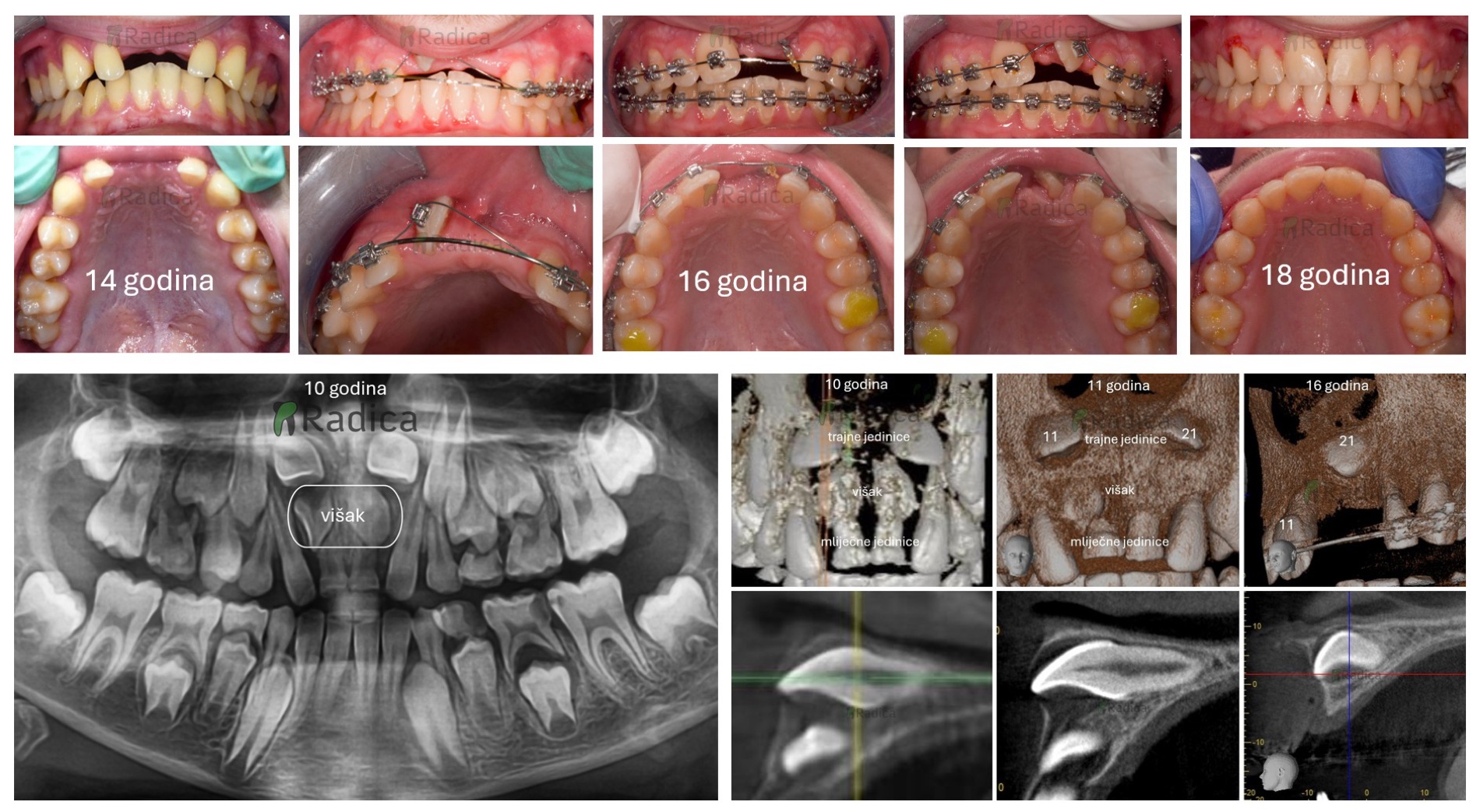 ortodont radica impaktirani zubi visak zuba izvlacenje zuba