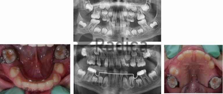 prerani gubitak mlijecnih zuba ortodont radica 768x326 1770214411857 623237827