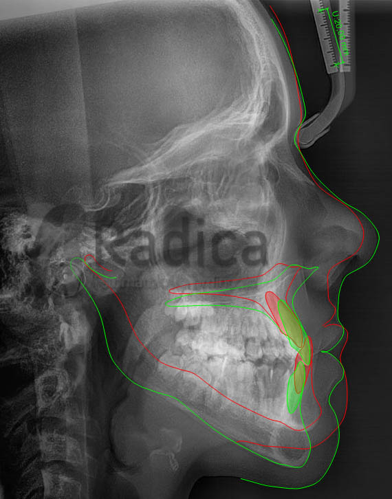 pseudoprogenijakefalometrilall ortodontradica 1767819538297 788597373