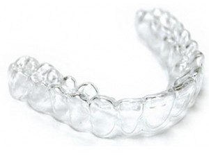 Retainer za zube u Splitu – cijene i vrste