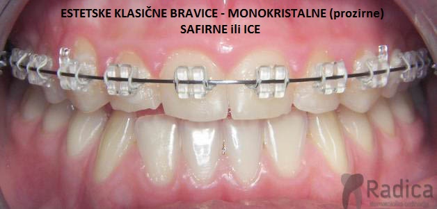 safirni Ice fiksni aparatic ordinacija radica 1770205908639 136356345