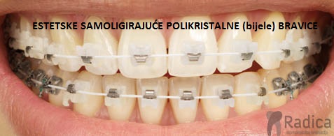 samoligirajuce estetsi aparatic split ortodont radica 1770205950576 537898185