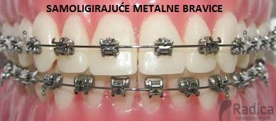 samoligirajuci metalini aparatic ortodont radica 1770205749881 506907540