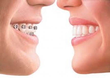 thumbsinvisalign 3 1771508930342 222142595