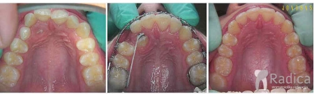 thumbsizvlacenje impaktiranih ocnjaka ortodoncija 1767739125007 451413155