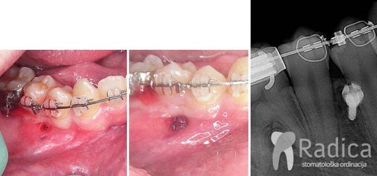 thumbslaser mikroimplantati 1767898186723 33193003