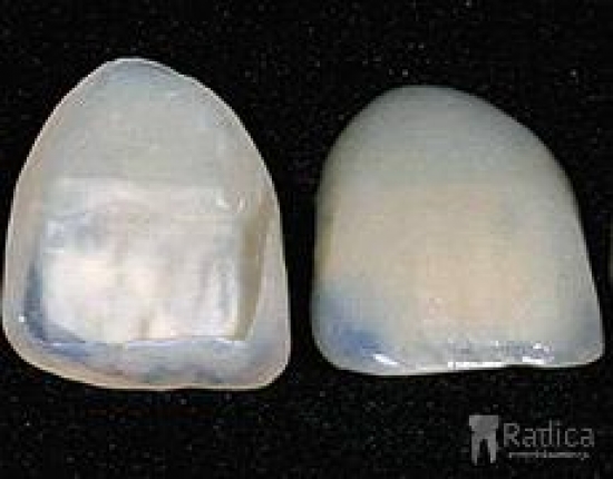 thumbsljuskice veneers 1767898320706 411884099