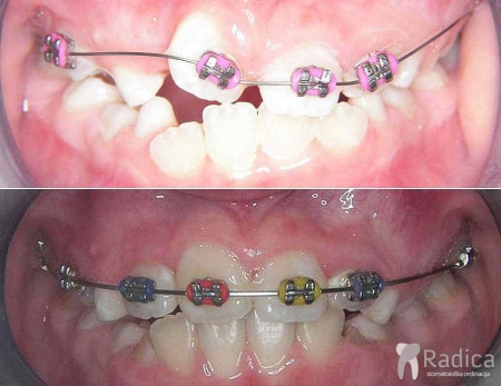 thumbsortodontska terapija fiksna mjesovita denticija 1767739332355 605174314