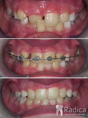 thumbsortodontska terapija fiksna mjesovita denticija 2 1767739378997 640166929