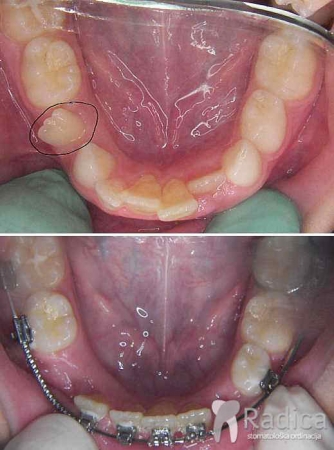 thumbsortodontska terapija fiksna mjesovita denticija 3 1767739403920 759833836