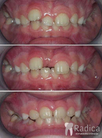 thumbsortodontska terapija fiksna mjesovita denticija 4 1767739448217 826387489