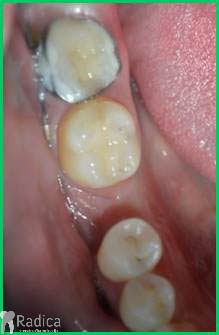thumbsortodontska terapija odrasli 050 mikroimplantat 1767652330079 571234462