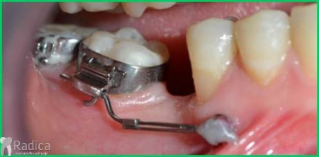 thumbsortodontska terapija odrasli 051mikroimplantat 1767652347730 523786756