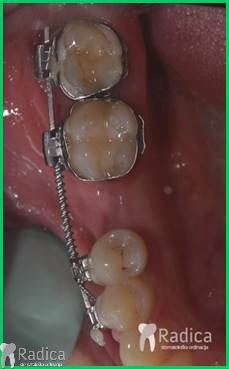 thumbsortodontska terapija odrasli 052 mikroimplantat 1767652363326 421393335