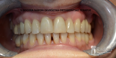 thumbsortodontska terapija odrasli 057 parodontitis 5 godnakon zavrsetka terapije 1 1767564825903 177484908