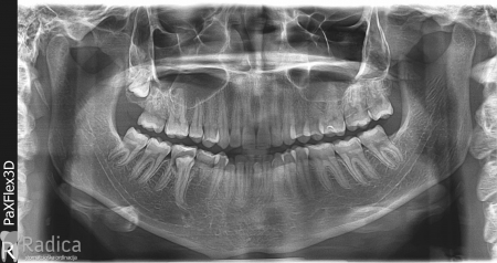 thumbsortodontska terapija odrasli 82 impaktirani premolar 1767735813844 525884945