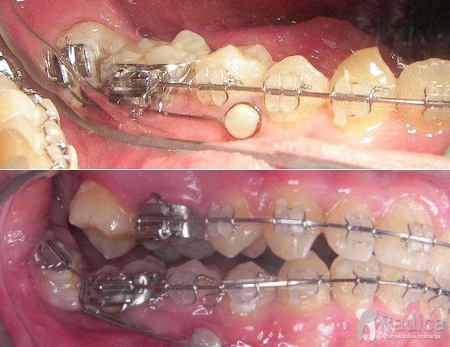 thumbsortodontski mikroimplantati 1 1767739548068 706831456