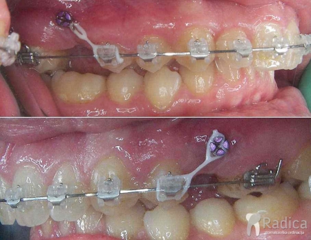 thumbsortodontski mikroimplantati 1767739496473 395773942