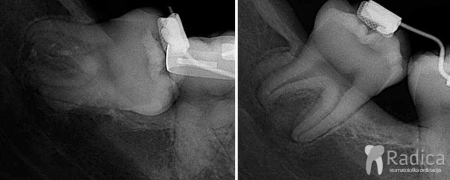 thumbsortodontski mikroimplantati 2 1767739560293 562147780