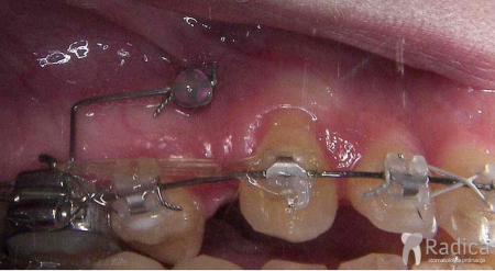thumbsortodontski mikroimplantati 3 1767739613939 958698250